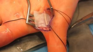 Tratamiento quirúrgico y reconstructivo de las lesiones del nervio periférico - Madrid Trauma