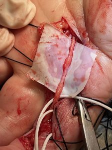 Tratamiento quirúrgico y reconstructivo de las lesiones del nervio periférico - Madrid Trauma