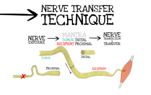 Tratamiento quirúrgico y reconstructivo de las lesiones del nervio periférico - Madrid Trauma